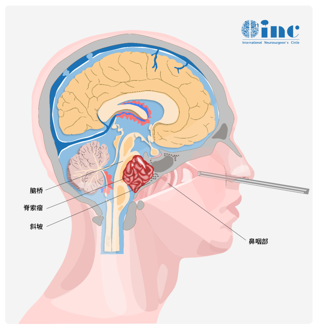 擴(kuò)大經(jīng)鼻入路與傳統(tǒng)開顱手術(shù)不同的是，經(jīng)鼻手術(shù)是將內(nèi)鏡和手術(shù)刀從鼻腔進(jìn)入，進(jìn)行腫瘤的切除手術(shù)，其成功率高，手術(shù)時間短，恢復(fù)快，住院時間短等優(yōu)勢是明顯的。