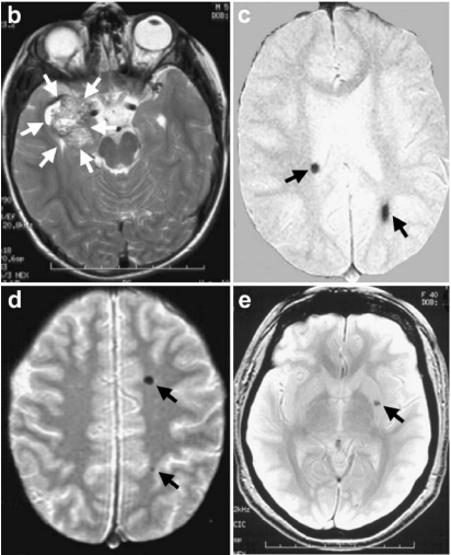 b. 軸位T2加權(quán)磁共振成像(MRI)顯示先證者(家系圖中箭頭所指)右側(cè)顳葉內(nèi)側(cè)大型海綿狀血管畸形(白色箭頭)，該病灶在顯微手術(shù)切除前被檢出。 c. 梯度回波MRI于雙側(cè)大腦半球發(fā)現(xiàn)多發(fā)性無(wú)癥狀海綿狀血管畸形(黑色箭頭)。 d. 患兒父親的軸位梯度回波MRI顯示左額葉及頂葉兩處小型無(wú)癥狀海綿狀血管畸形(箭頭)。 e. 家系中一位姑姑(II-5)同樣在左側(cè)基底節(jié)區(qū)檢出無(wú)癥狀海綿狀血管畸形(箭頭)。