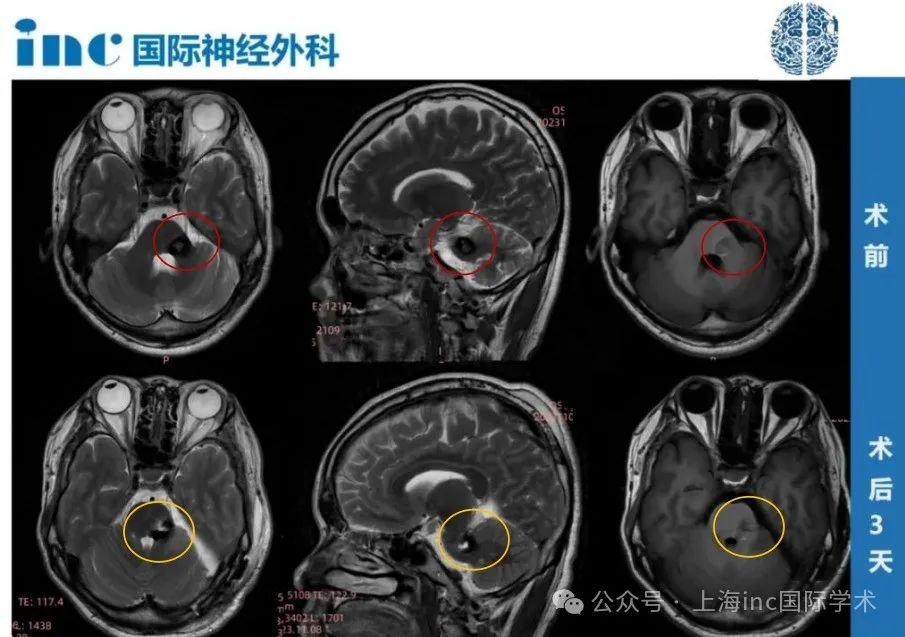 術(shù)后第1天，盧先生就從ICU，轉(zhuǎn)入普通病房，術(shù)前他所擔(dān)心的面癱也都沒(méi)有發(fā)生。