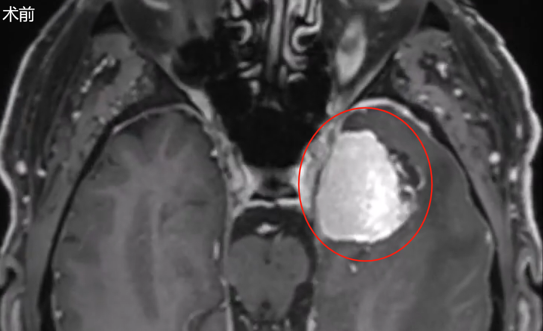 術(shù)前mri