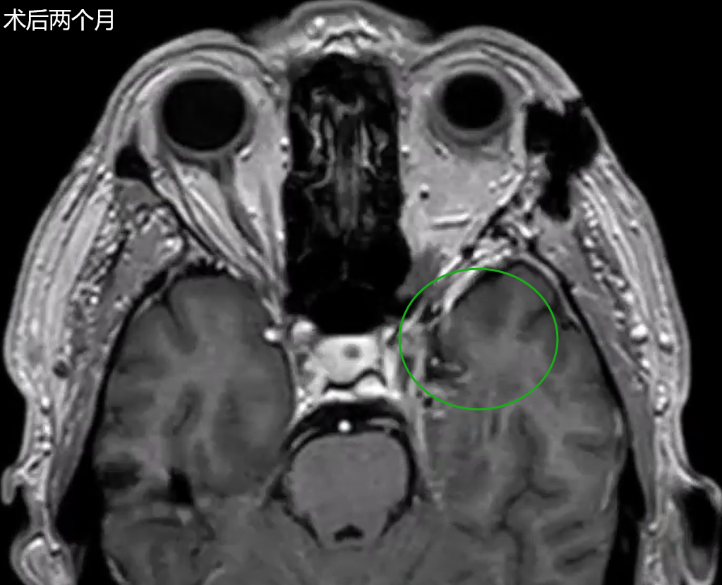 術(shù)后兩個月MRI