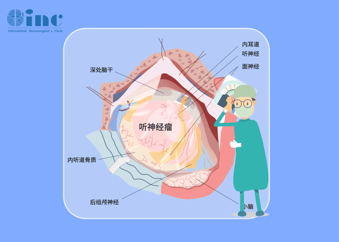 聽神經(jīng)瘤治療理念先于手術(shù)，需要在保面、保聽的先行理念下謹(jǐn)慎進(jìn)行手術(shù)切除。放眼全球，國外的診療早已將“盡可能全切”、“不面癱”、“保留聽力”三要素作為聽神經(jīng)瘤手術(shù)成功的標(biāo)準(zhǔn)，功能保留逐漸成為治療的首要目標(biāo)。