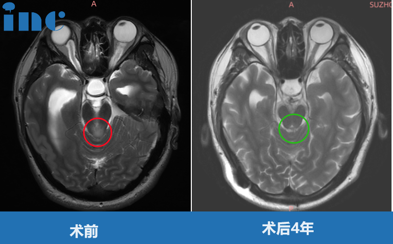 罹患中腦頂蓋腫瘤，被判無法手術(shù)的他：“如今我當(dāng)爸爸了！”