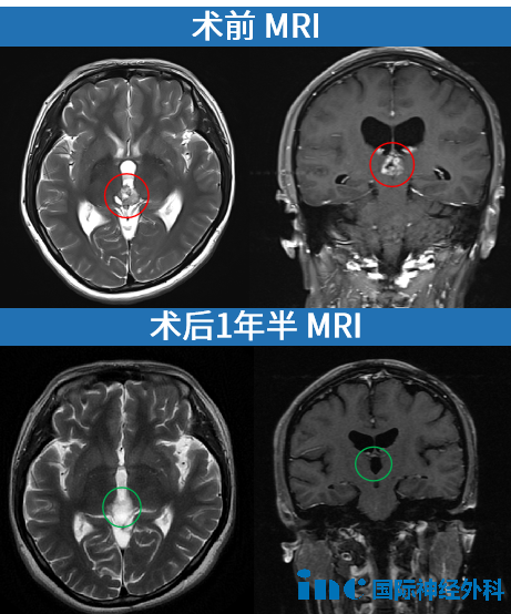 MRI影像