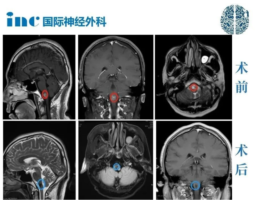 腦干海綿狀血管瘤手術(shù)