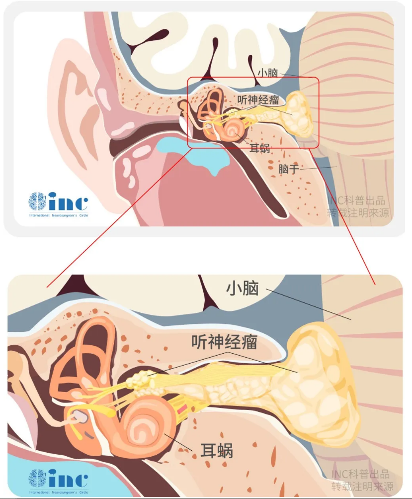 聽神經(jīng)瘤治療原理