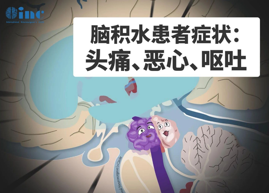 腦積水患者癥狀：頭痛、惡心、嘔吐