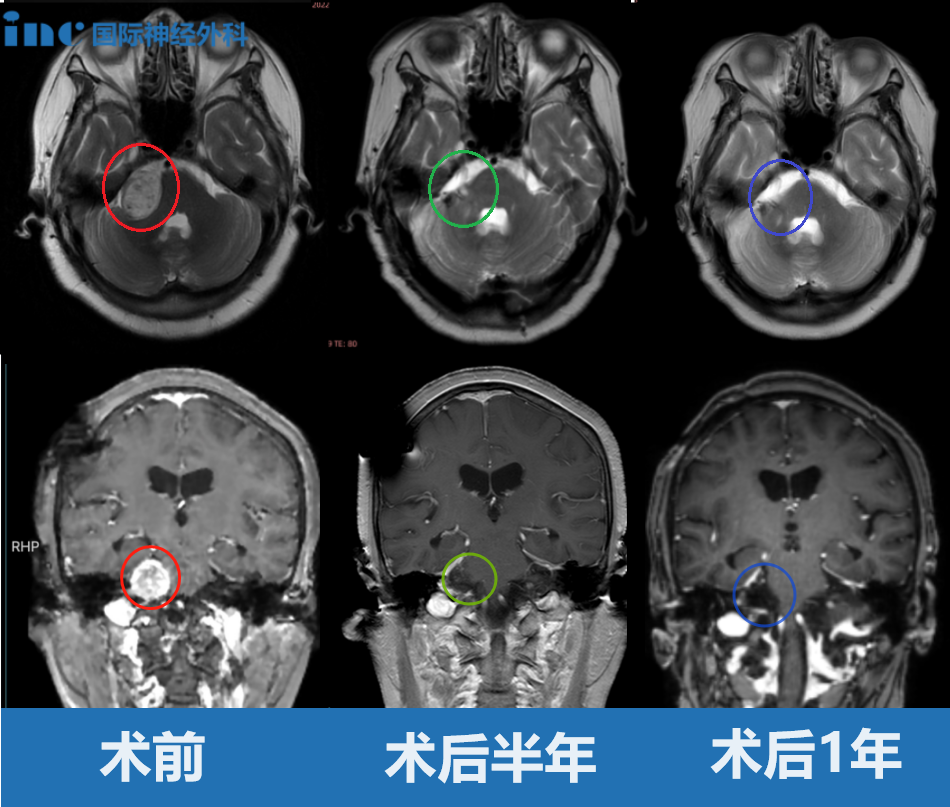 聽神經(jīng)瘤擠壓變形