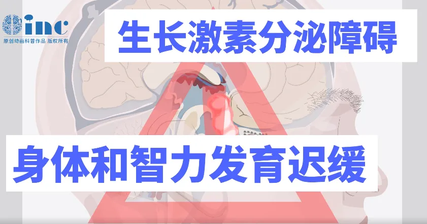 警惕顱咽管瘤！孩子生長發(fā)育的 “攔路虎”