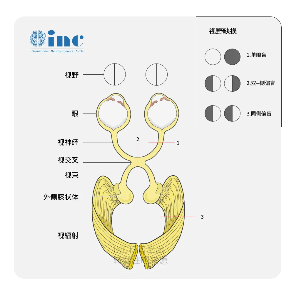 視束繼發(fā)受累