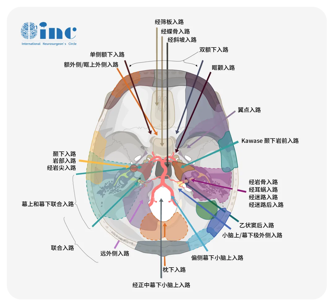 鞍結(jié)節(jié)腦膜瘤的手術(shù)入路