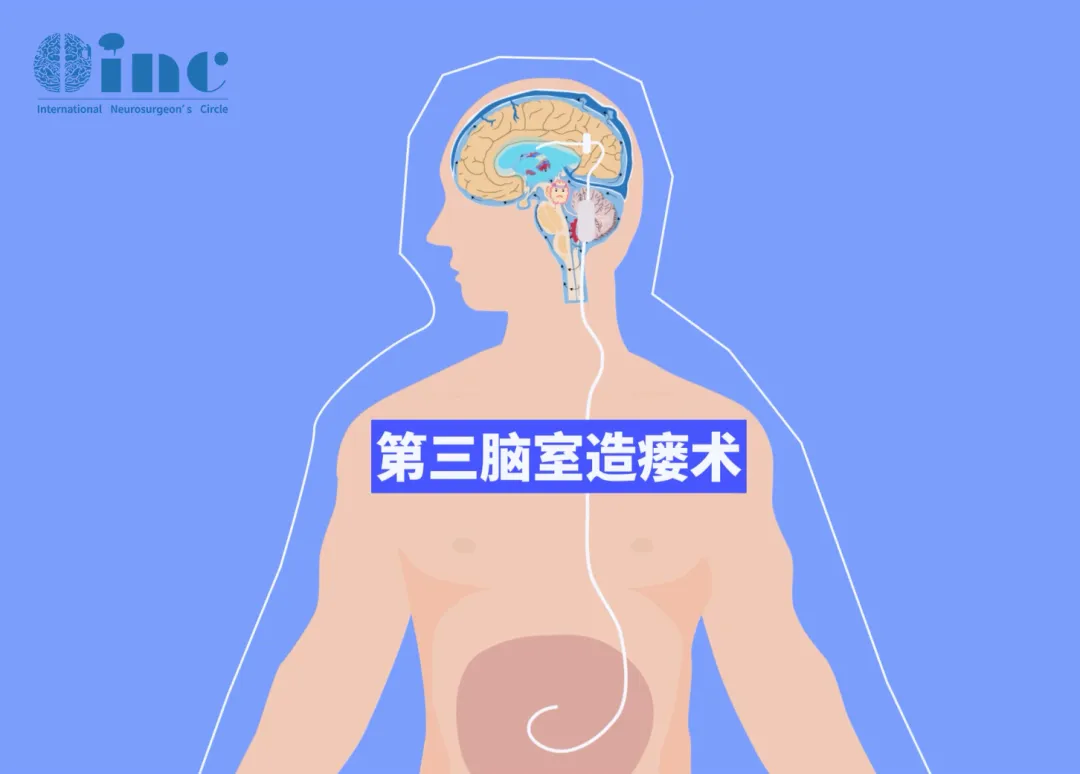 神經(jīng)內(nèi)鏡下第三腦室造瘺術(shù)