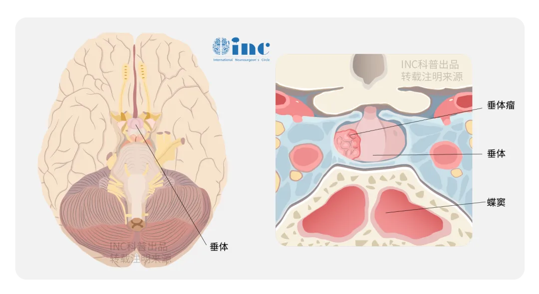 垂體大腺瘤導(dǎo)致內(nèi)分泌風(fēng)暴