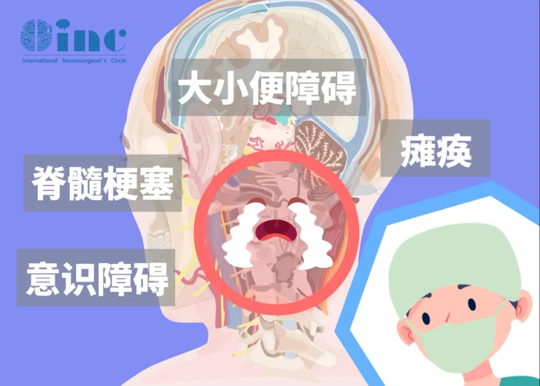 脊髓腫瘤手術風險高？一文讀懂手術要點、腫瘤差異及專家選擇