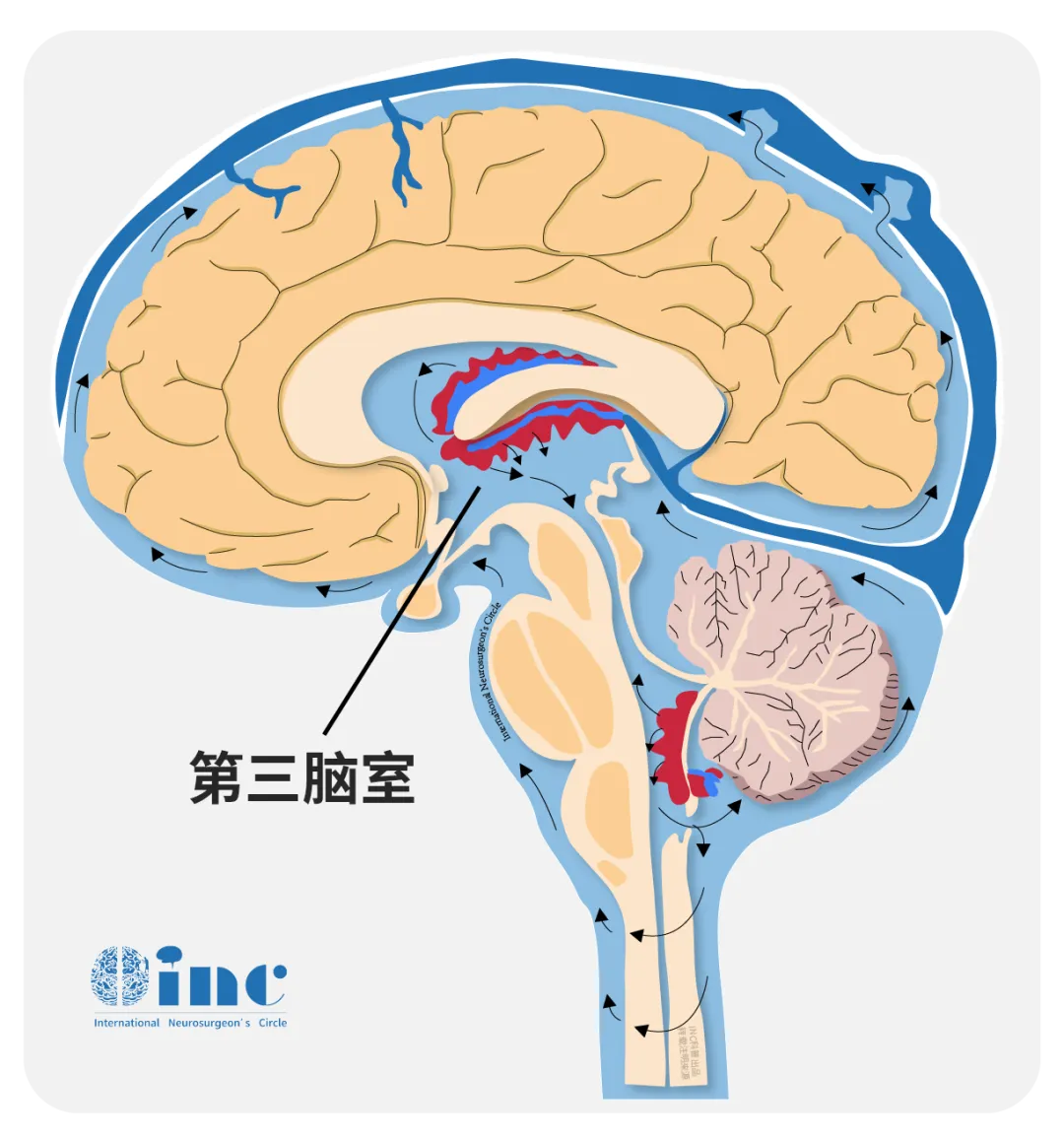 什么是腦脊液漏？