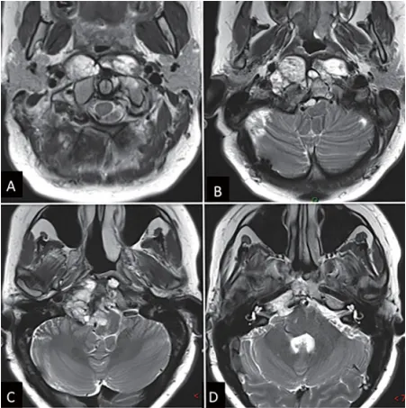 內(nèi)鏡下鼻內(nèi)鏡入路前的術(shù)前影像。(A - D) MRI T2 WI顯示一個巨大脊索瘤延伸至椎前間隙和齒狀突周圍。腫瘤橫向延伸至舌下管和頸靜脈孔，并向內(nèi)側(cè)延伸至硬膜內(nèi)間隙。腫瘤從斜坡中部延伸至樞椎齒狀突周圍。