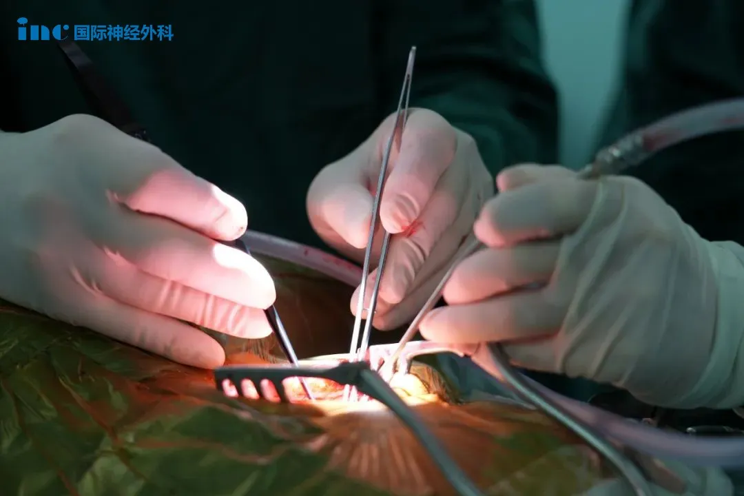 INC巴教授手術(shù)“超感之手”，觸一觸就知腫瘤在哪？