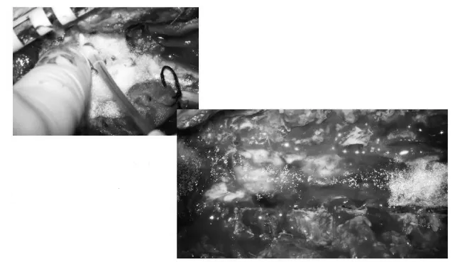硬膜表面鋪蓋速即棉后生物膠水再次覆蓋，防止腦脊液漏