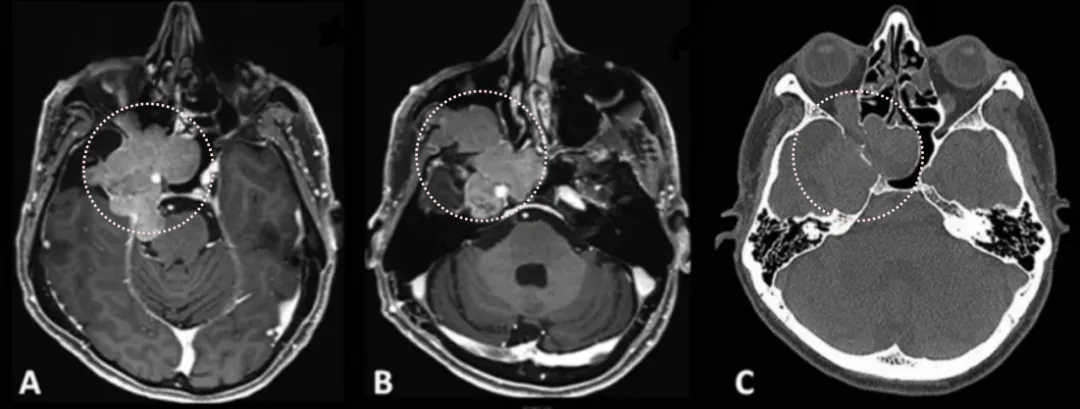 患者術前影像。（A）術前軸位T1加權釓增強磁共振成像（MRI），顯示腦膜瘤延伸至后顱窩、海綿竇、眼眶和蝶竇。（B）腫瘤延伸至中顱窩、翼腭窩和顳下窩。（C）術前軸位計算機斷層掃描（CT）顯示蝶骨大翼侵蝕和蝶竇受累。