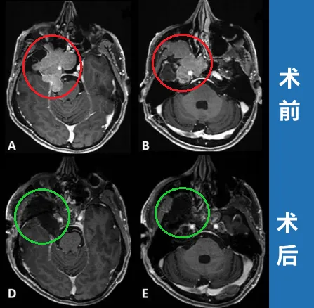 (A)術前軸向t1加權釓增強磁共振成像(MRI)顯示腦膜瘤延伸至后顱窩(PF)、海綿竇(CS)、眼眶和蝶竇(SS)。(B)腫瘤延伸至中窩、翼腭窩(PPF)和顳下窩(ITF)。(D, E)術后軸向t1加權釓增強MRI顯示腫瘤完全切除。