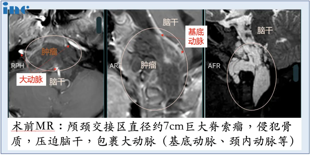 經(jīng)鼻孔成功夾出大脊索瘤？這雙“筷子”太神奇！