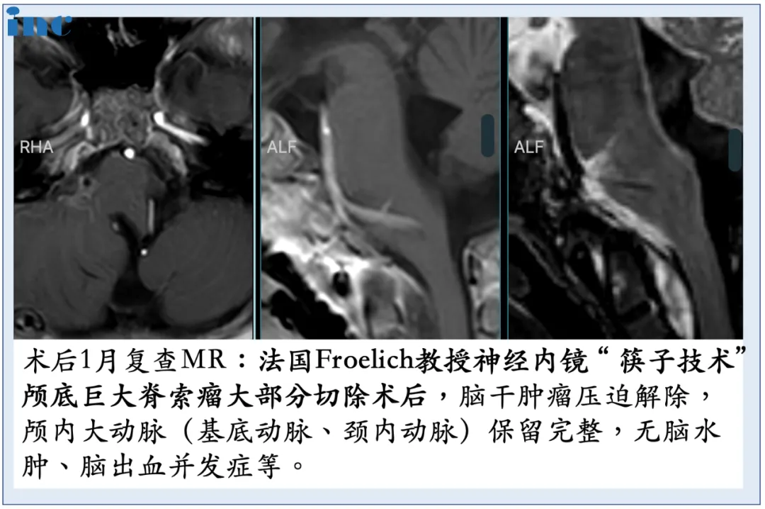 術(shù)后復(fù)查MR