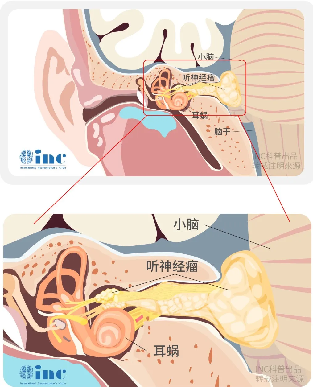 聽神經(jīng)瘤的全切除術(shù)