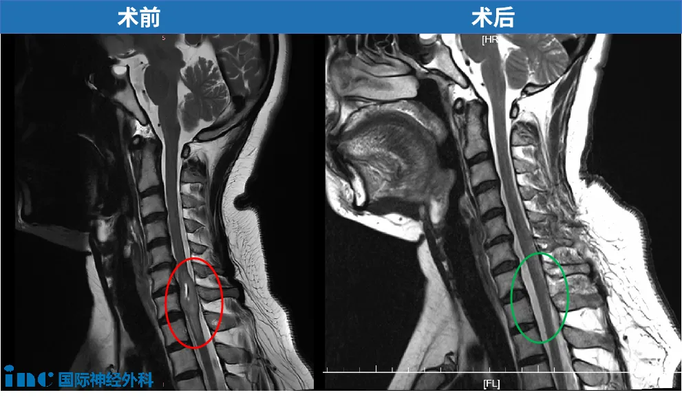 術(shù)前術(shù)后