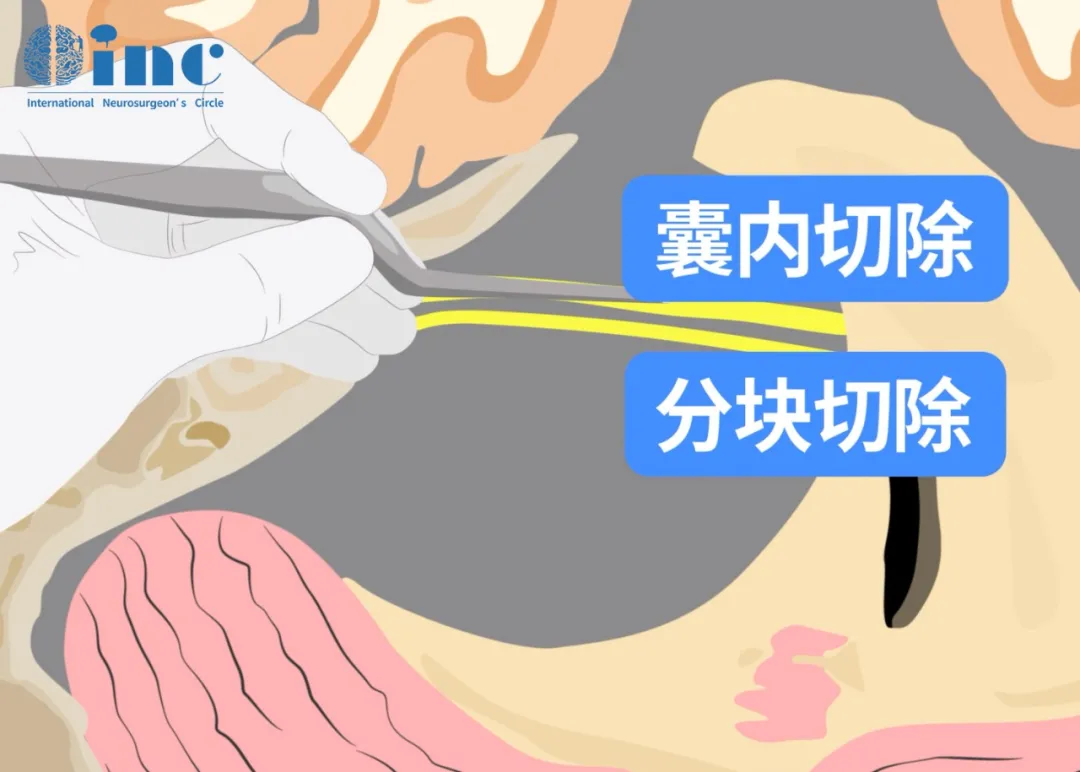 膜內(nèi)腫瘤切除術