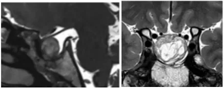 術(shù)后一年MRI