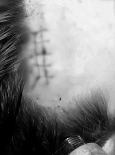 術(shù)后手術(shù)切口特寫