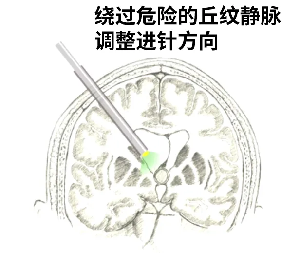 繞過危險(xiǎn)得丘紋靜脈調(diào)整進(jìn)針方向
