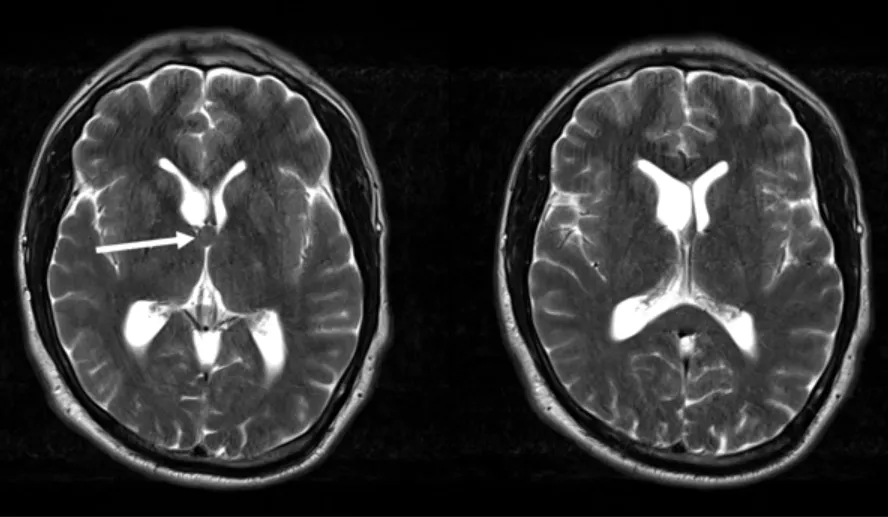 術(shù)前 MRI 顯示此處靜脈紋極為顯著