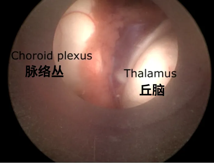 脈絡(luò)叢和丘腦