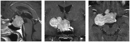磁共振成像（MRI）檢查揭示了一個位于右側、緊靠垂體區(qū)域的大型垂體腺瘤，并且該腫瘤在注射對比劑后呈現(xiàn)吸收現(xiàn)象。