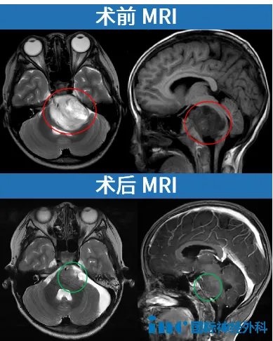 術前術后MRI