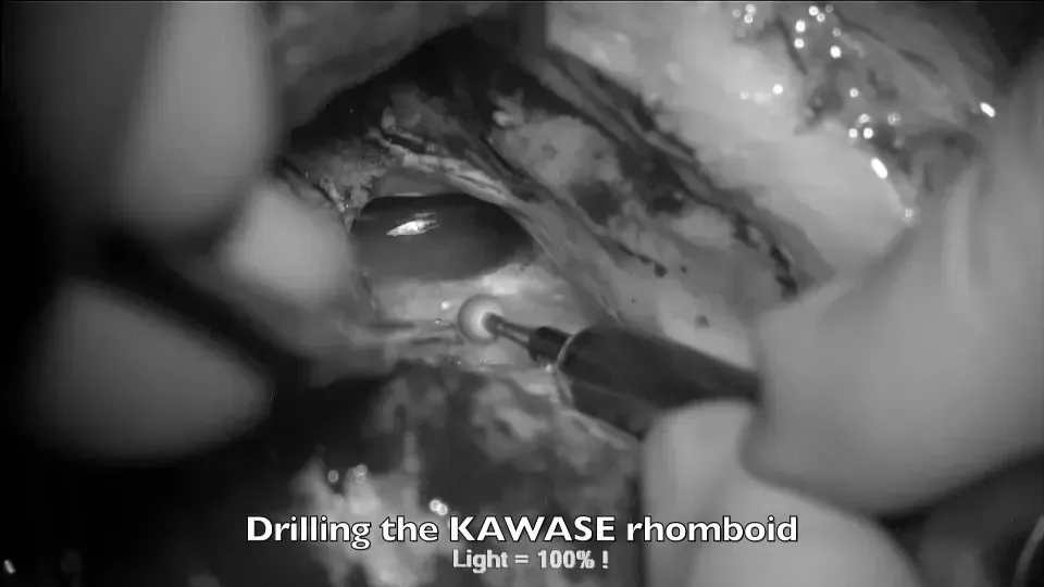 磨除KAWASE菱形區(qū)