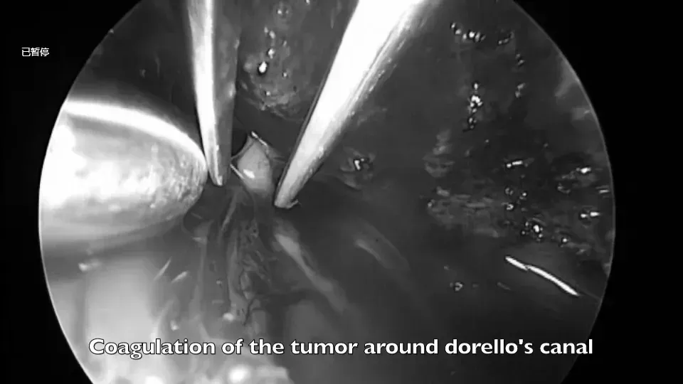 Dorello管周圍的腫瘤進行分離