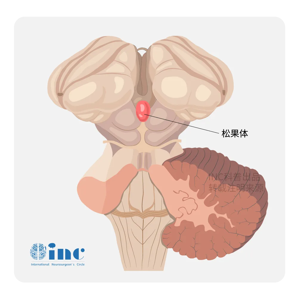 松果體區(qū)腫瘤的生長會直接壓迫或阻塞這些結(jié)構(gòu)，影響腦脊液的正常流動。