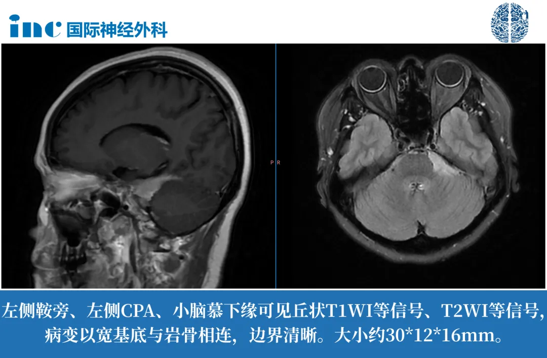 腦膜瘤影響