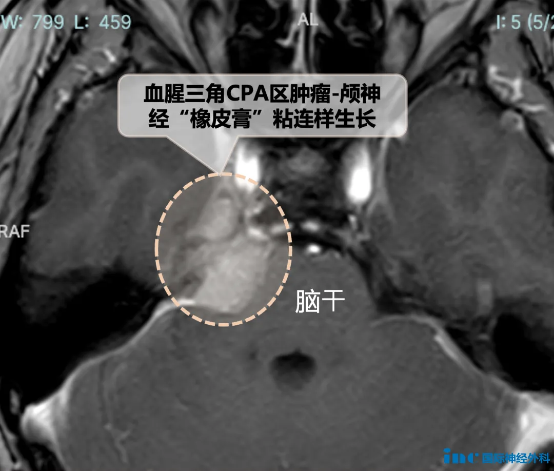 生命中樞的橋腦和中腦也受到壓迫