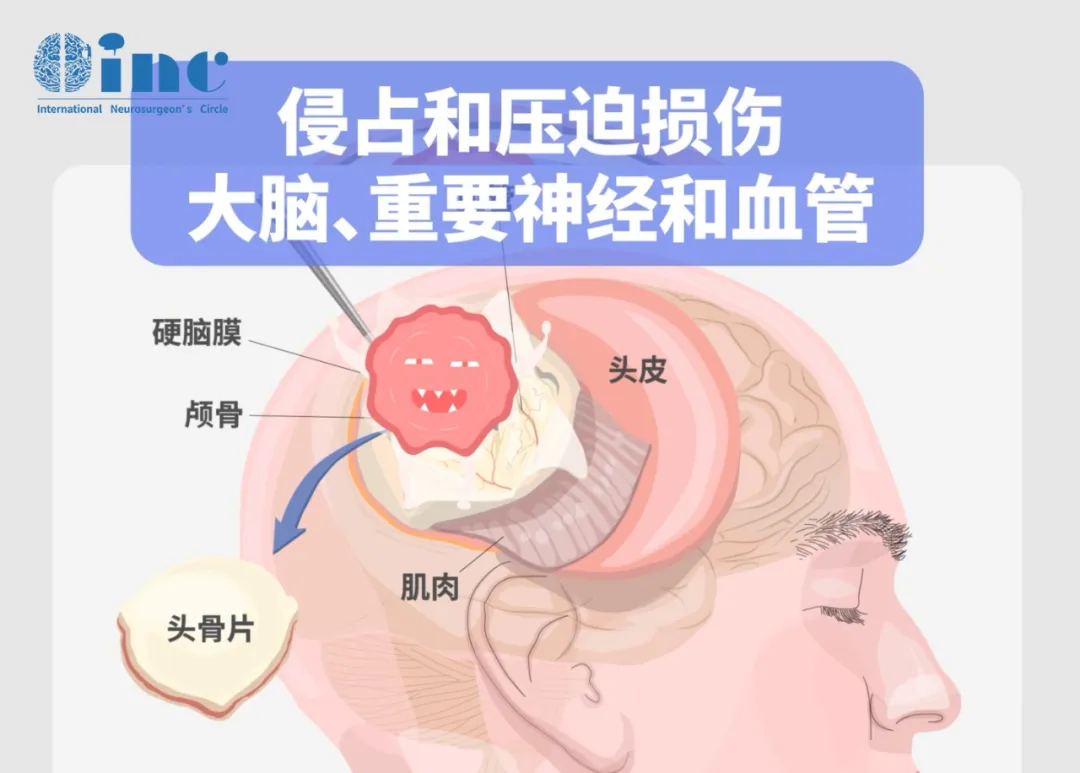 侵占和壓迫損傷大腦、重要神經(jīng)和血管