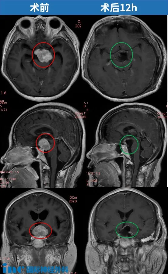 讓大腦意識不到曾被手術
