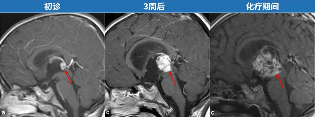不斷長大的<a href='/naoliu/' target='_blank'><u>腦瘤</u></a>：化療、干細胞治療均無效