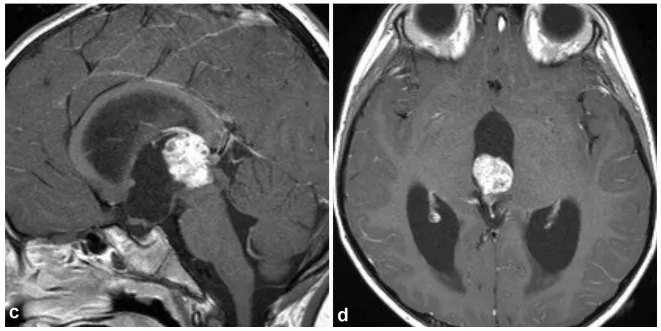 3周后的T1加權(quán)增強矢狀位（c）和軸位（d）MRI