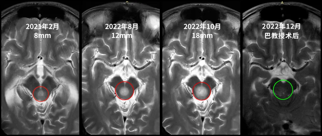 腦積水緩解≠腫瘤穩(wěn)定