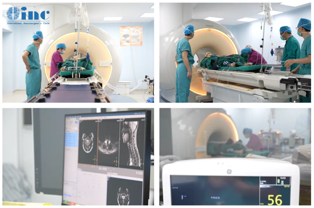 術(shù)中核磁（intraoperative MRI，簡(jiǎn)稱(chēng)iMRI，又稱(chēng)術(shù)中磁共振）能夠在手術(shù)過(guò)程中的任何時(shí)刻確定大腦內(nèi)腫瘤的準(zhǔn)確位置，使術(shù)中“實(shí)時(shí)”（real-time）成像成為可能，從而為神經(jīng)外科醫(yī)生提供了實(shí)時(shí)更新的腦部GPS影像地圖