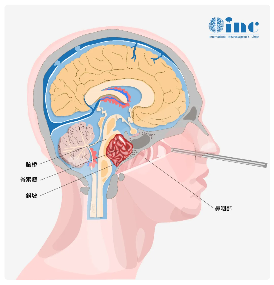 顯微鏡+神經(jīng)內(nèi)鏡-“雙鏡聯(lián)合”的手術(shù)