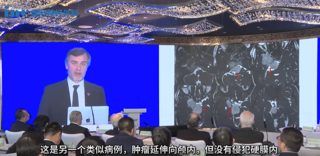 腫瘤尚未侵犯硬膜內(nèi)，因此必須立即采取行動(dòng)