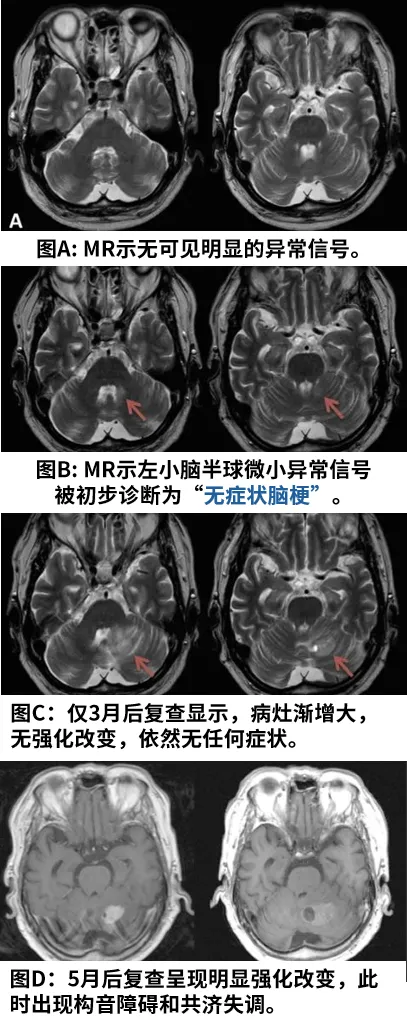 一個膠質瘤從無到有的完整發(fā)展史